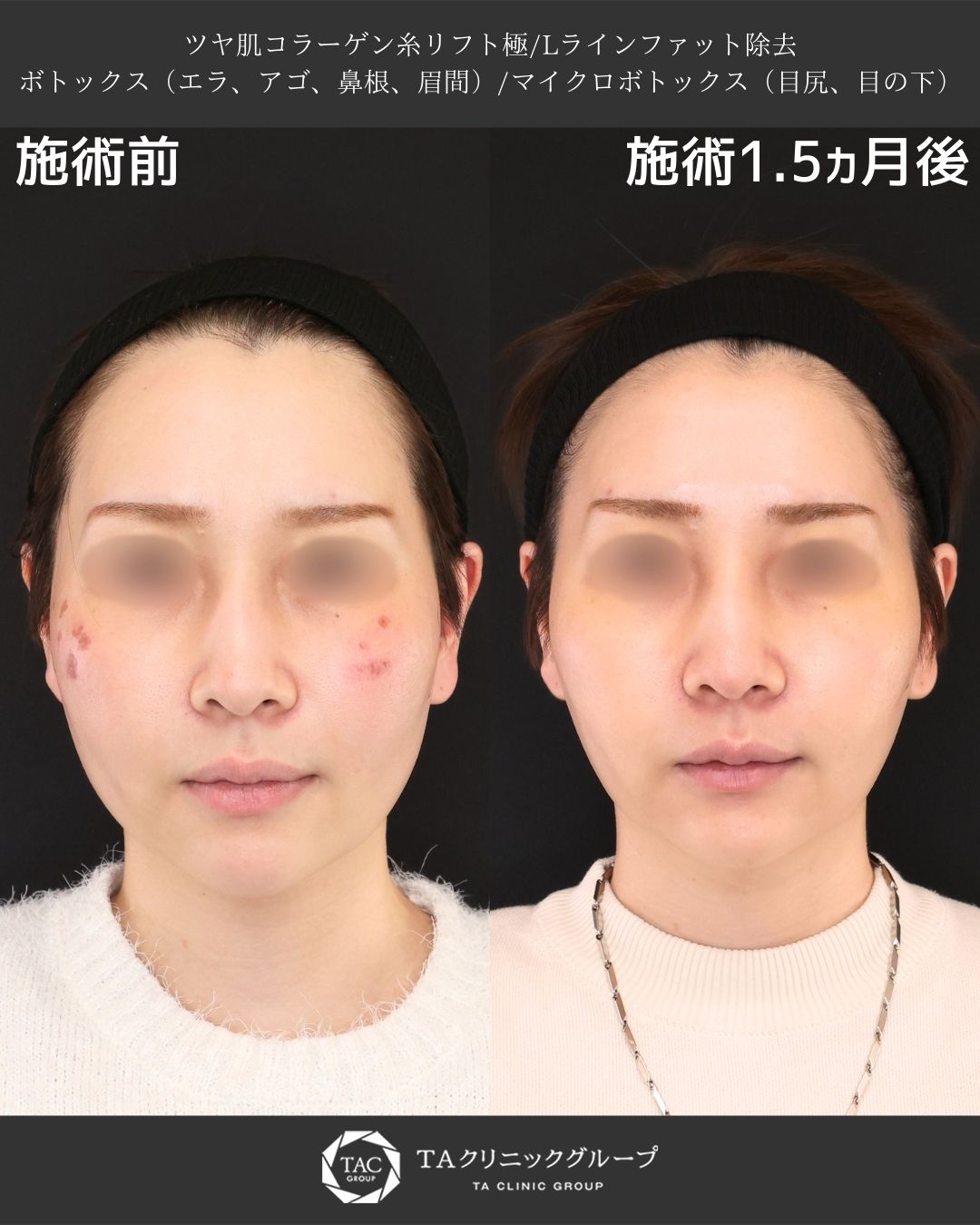 輪郭すっきり＆ハリツヤ肌へ 複合施術で自然な美しさを引き出す