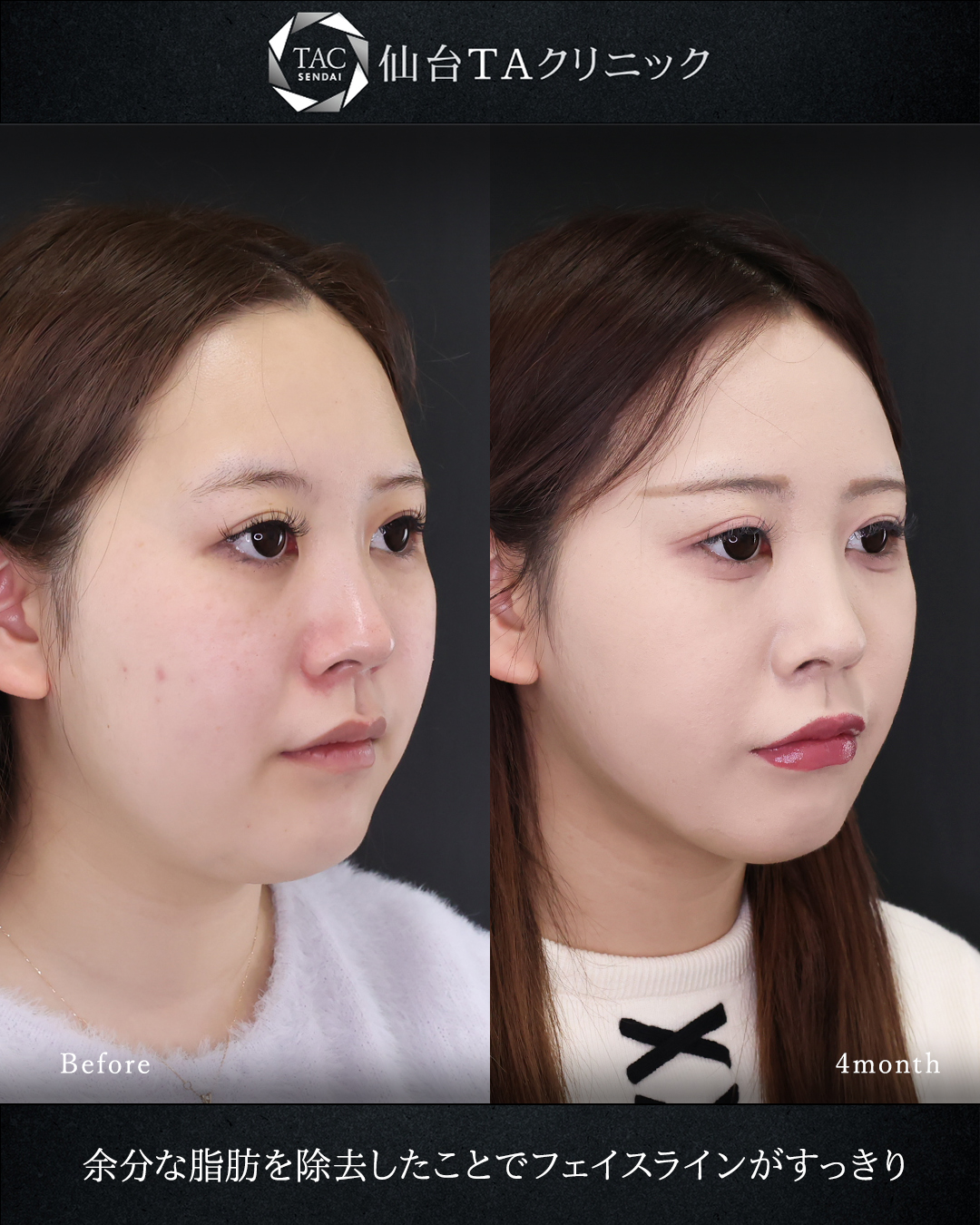 顎下の脂肪吸引/ジョールファット除去/TAC式 ツヤ肌コラーゲンリフト®の症例写真 施術前後 