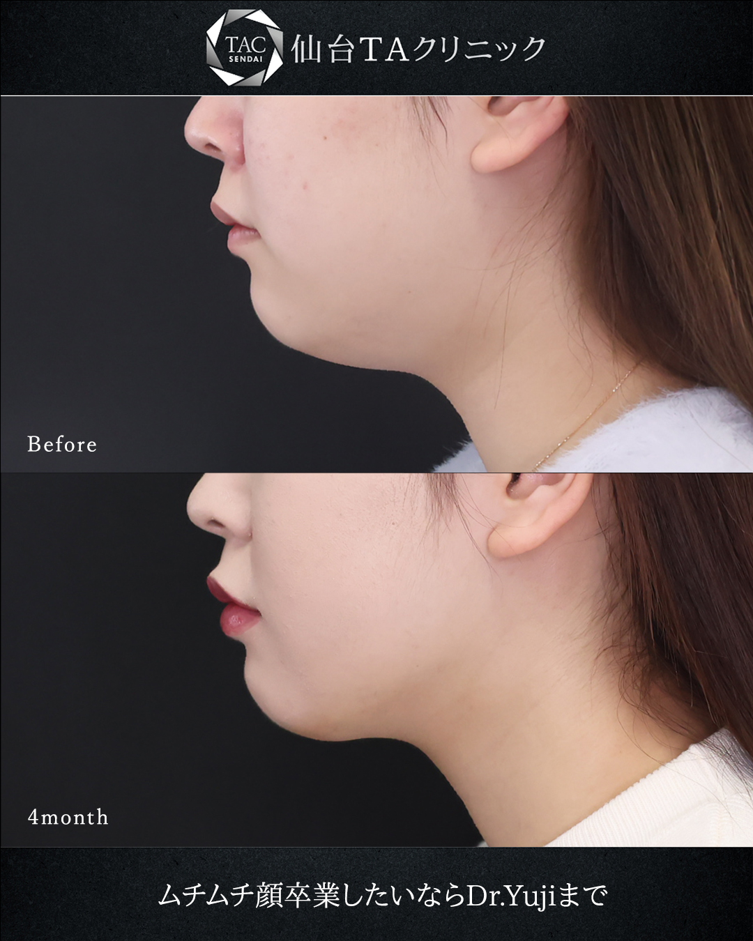 顎下の脂肪吸引/ジョールファット除去/TAC式 ツヤ肌コラーゲンリフト®の症例写真 施術前後 
