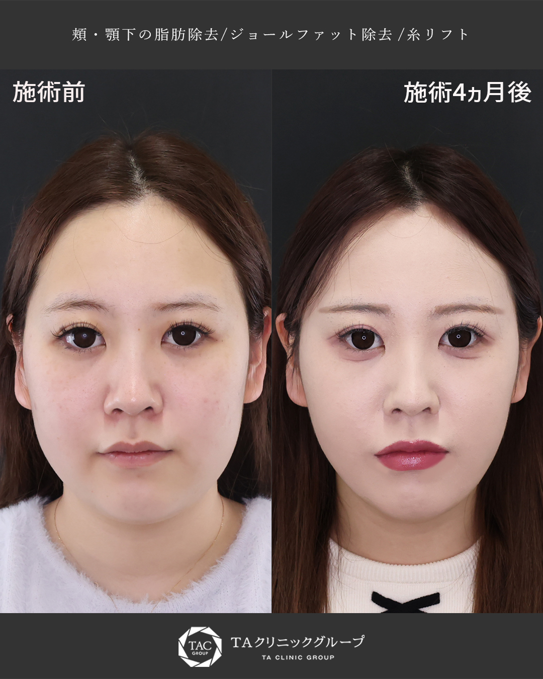 【ムチムチ顔卒業】顔の脂肪撃退