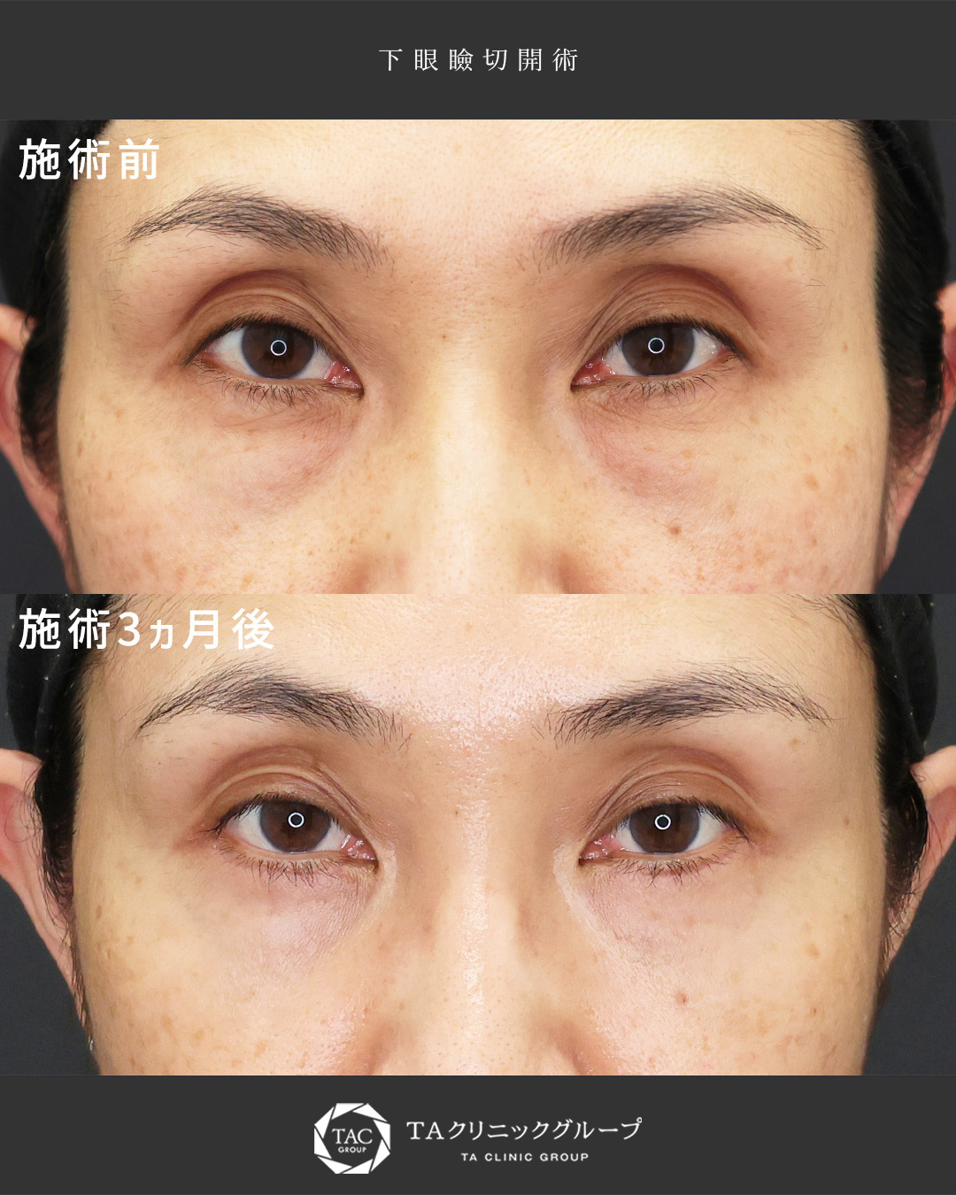 40代｜目の下のたるみ改善【目元若返り術】