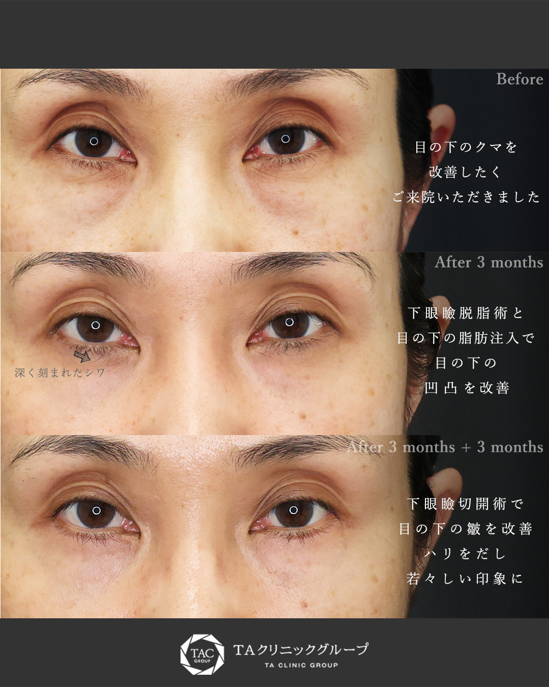 下眼瞼切開術（クマ・たるみとり）/下眼瞼脱脂術（目の下のたるみ取り・目の下の脂肪ふくらみ取り）/顔の脂肪注入(コンデンスリッチフェイス)の症例写真 施術前後 