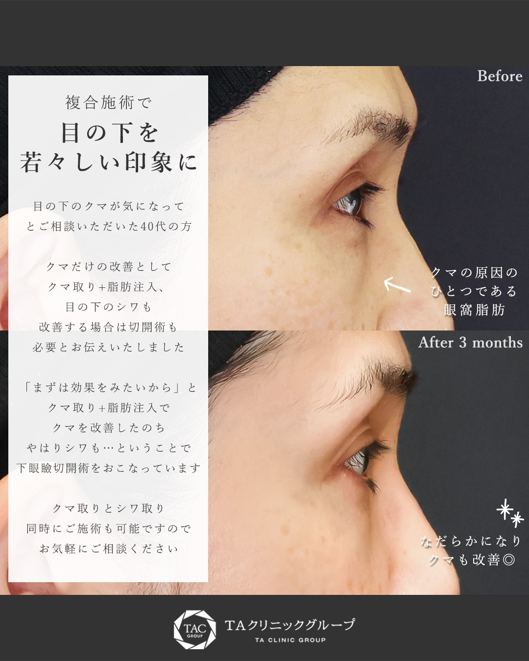 下眼瞼切開術（クマ・たるみとり）/下眼瞼脱脂術（目の下のたるみ取り・目の下の脂肪ふくらみ取り）/顔の脂肪注入(コンデンスリッチフェイス)の症例写真 施術前後 