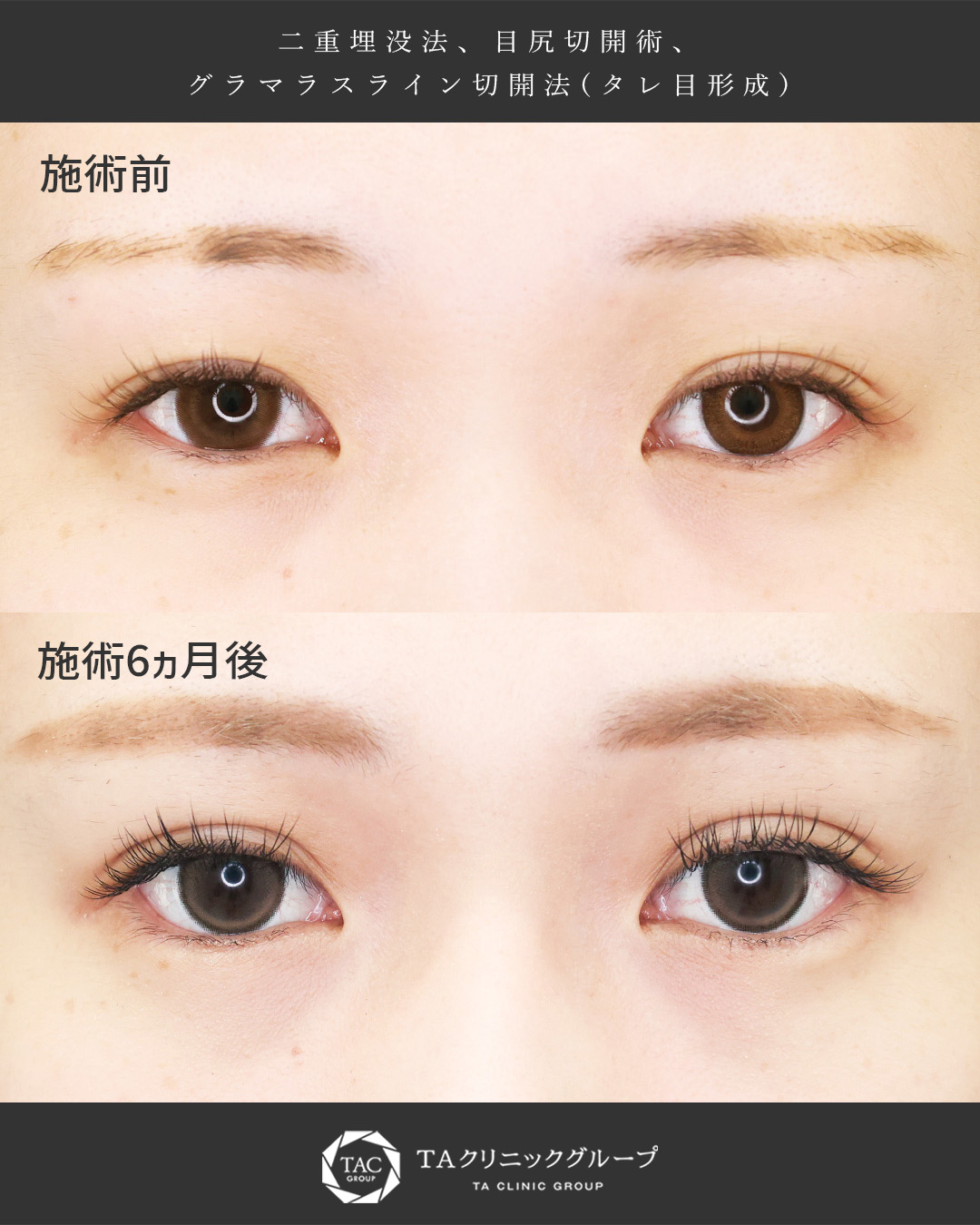 【二重埋没×目尻切開×タレ目形成】一回り大きな瞳でより印象的に｜半年間の経過症例