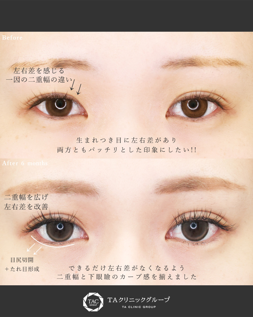 二重埋没法/グラマラスライン（タレ目形成）/目尻切開術の症例写真 施術前後 