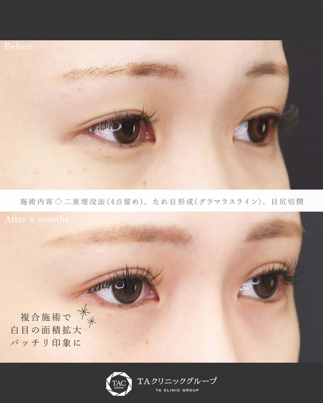 二重埋没法/グラマラスライン（タレ目形成）/目尻切開術の症例写真 施術前後 