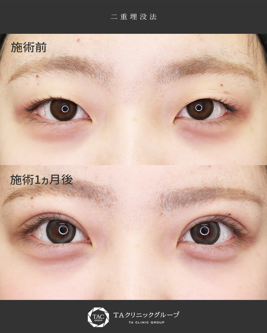 【奥二重→Mix型へ】大学生の二重埋没法