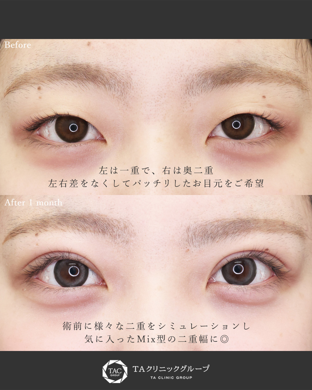 二重埋没法の症例写真 施術前後 