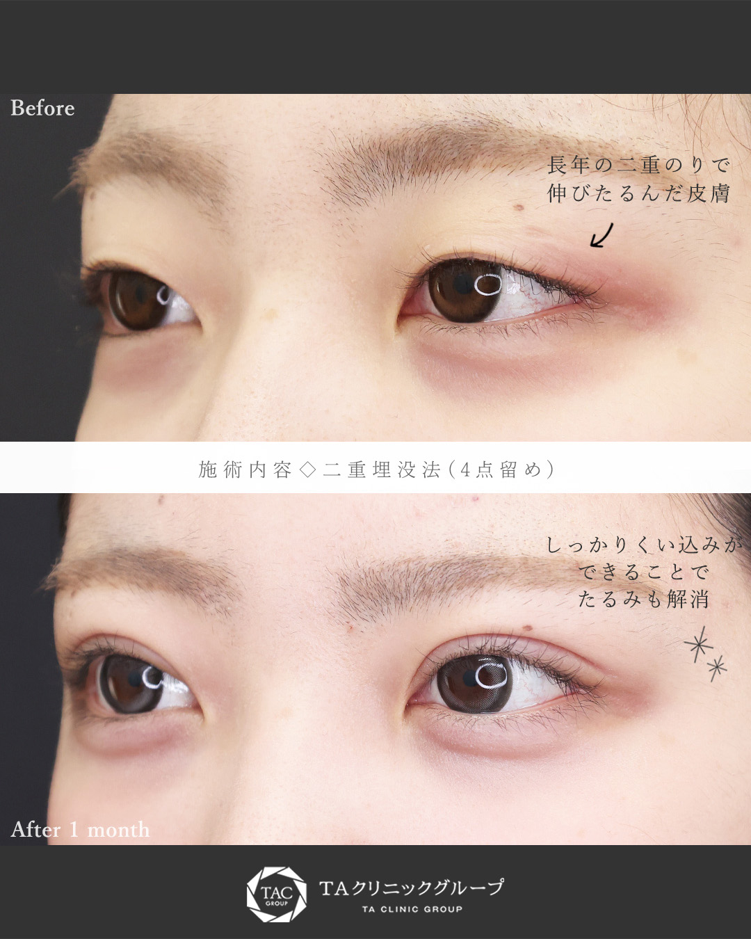 二重埋没法の症例写真 施術前後 