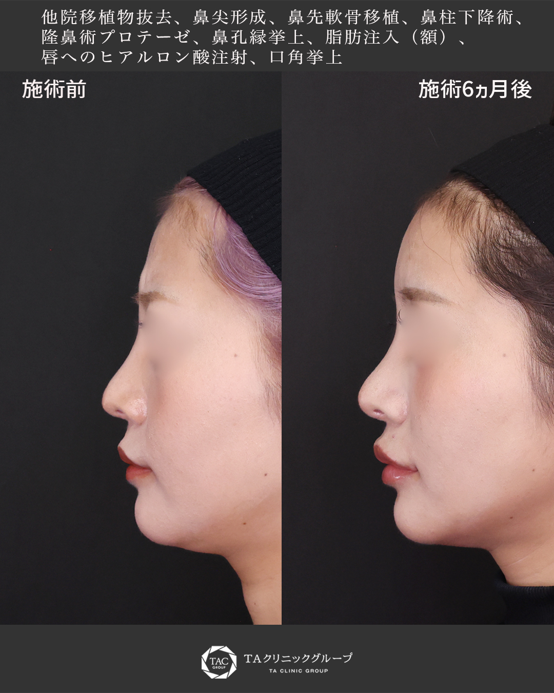 【鼻の他院修正】自然で美しいラインを再構築