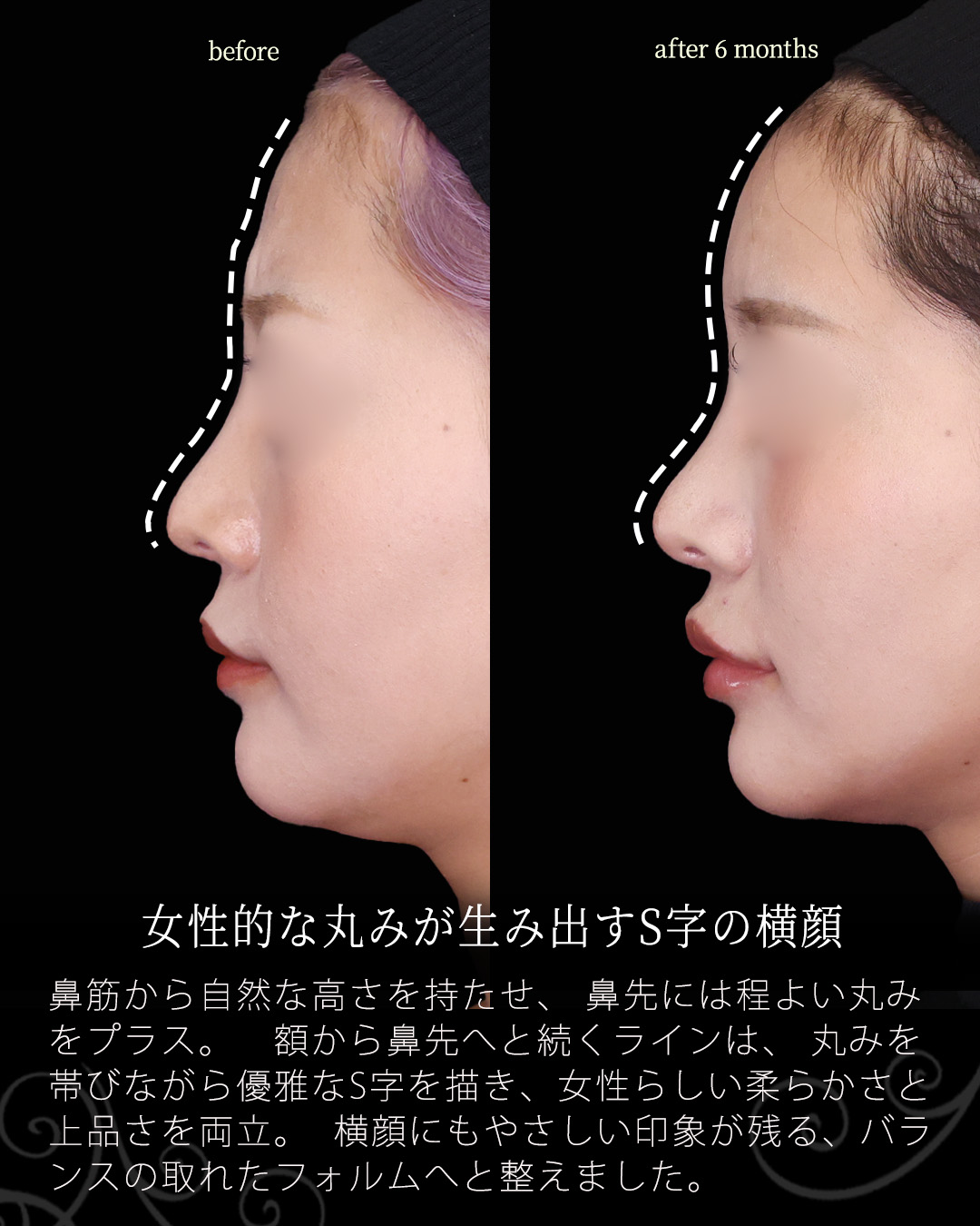 鼻尖形成・鼻尖縮小/鼻先軟骨移植/鼻中隔延長術の症例写真 施術前後 