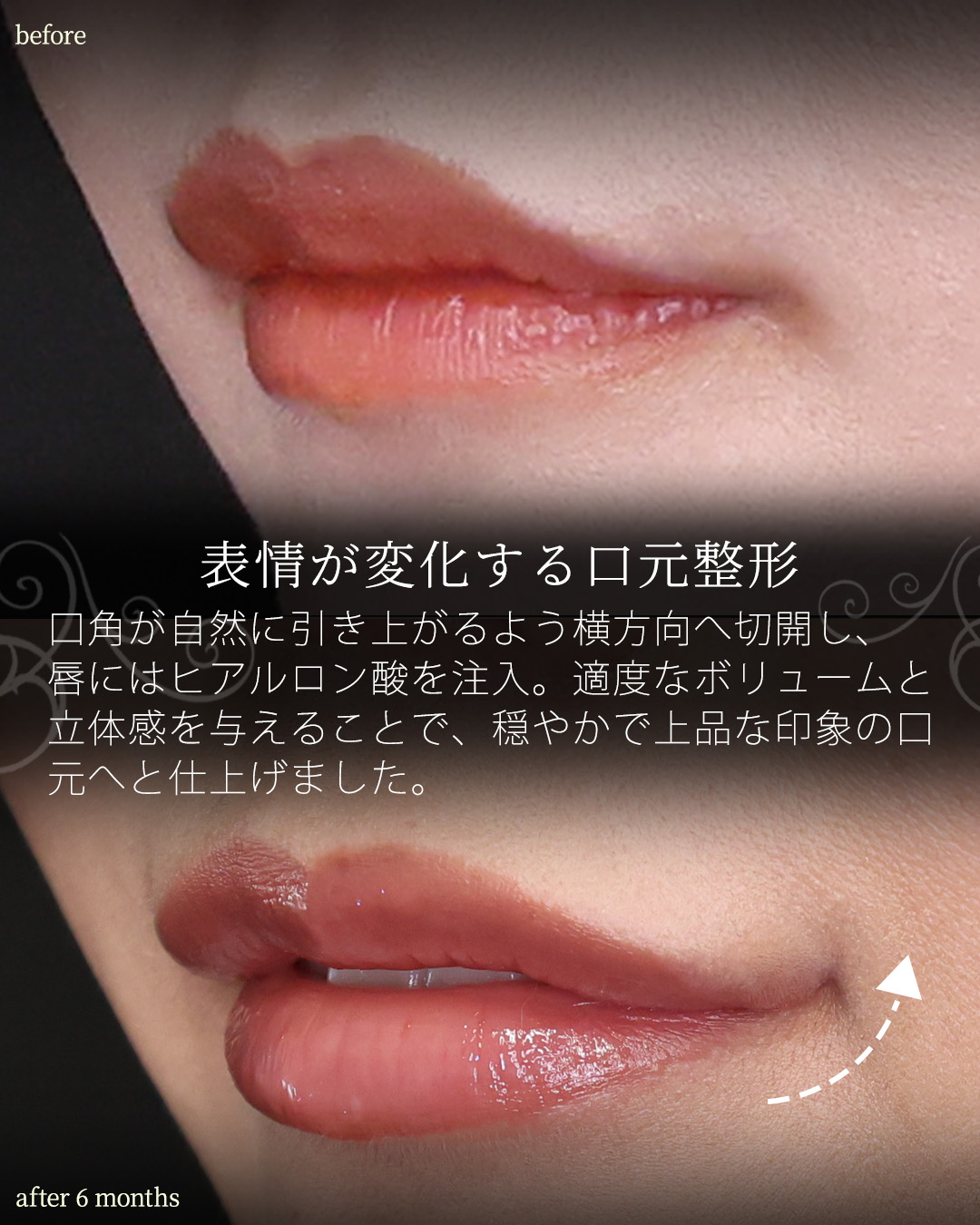 鼻尖形成・鼻尖縮小/鼻先軟骨移植/鼻中隔延長術の症例写真 施術前後 