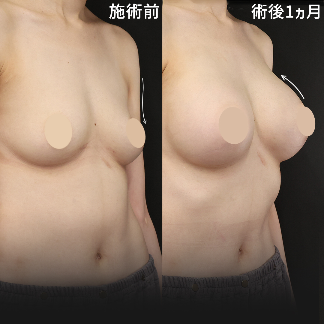 【シリコンバック豊胸】術後1ヵ月で自然な美乳に！！