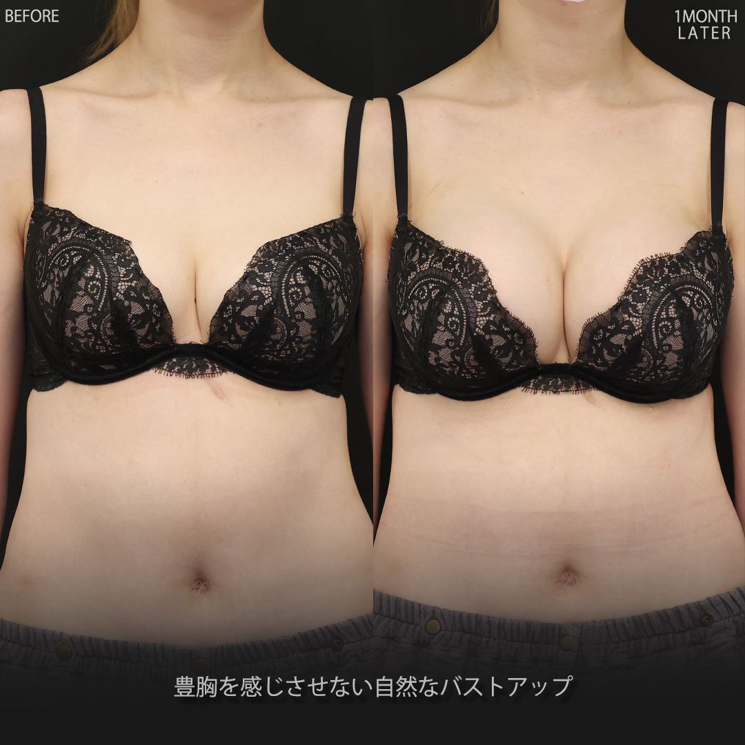 豊胸・バスト：その他/シリコンバッグ豊胸（人工乳腺バッグ）の症例写真 施術前後 