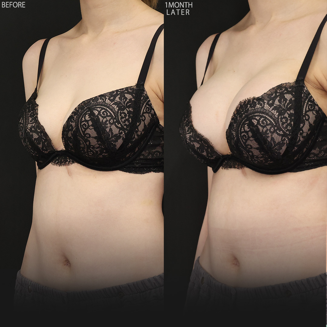 豊胸・バスト：その他/シリコンバッグ豊胸（人工乳腺バッグ）の症例写真 施術前後 