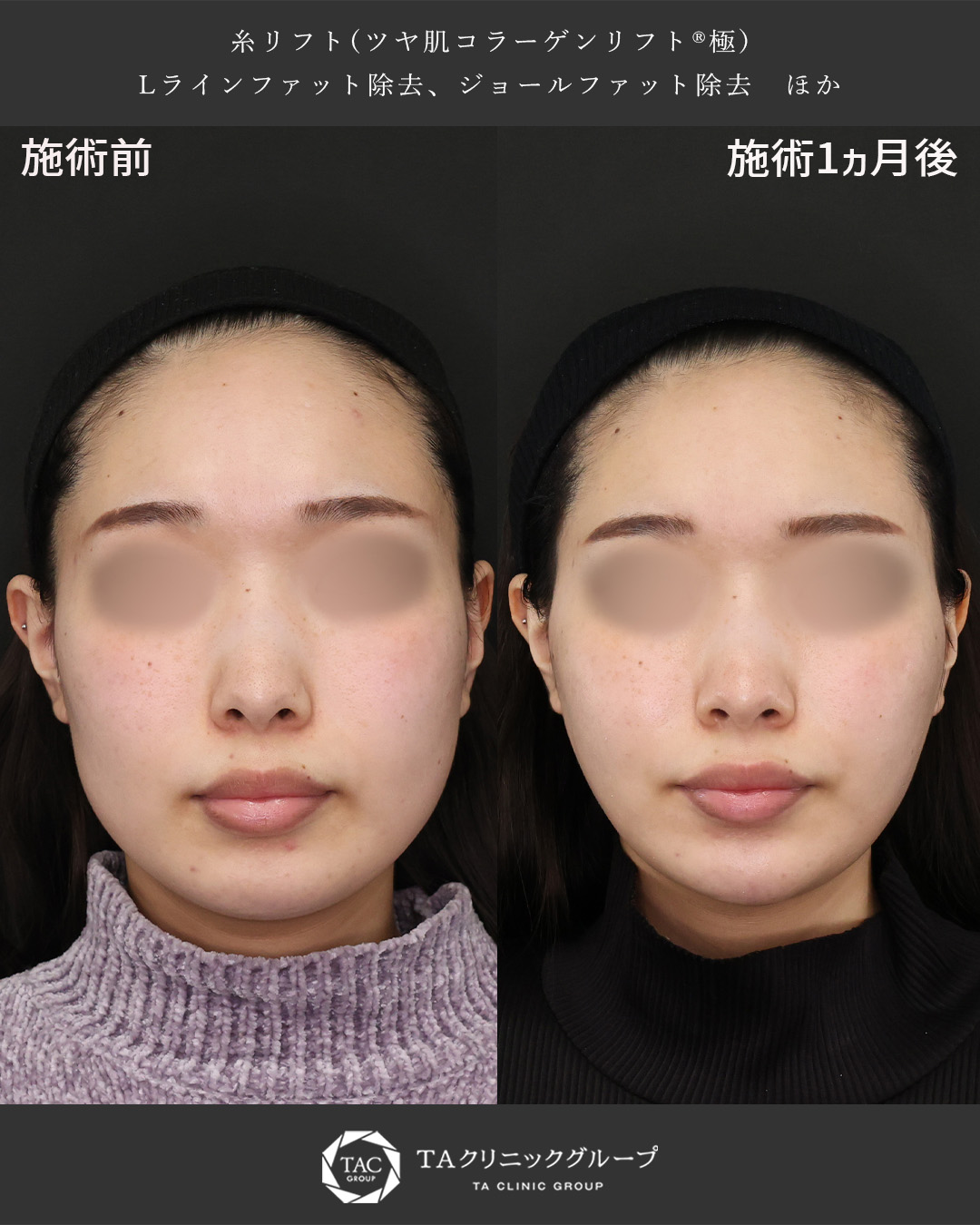 「小顔になりたいけど何をすればいいかわからない」20代女性の小顔整形