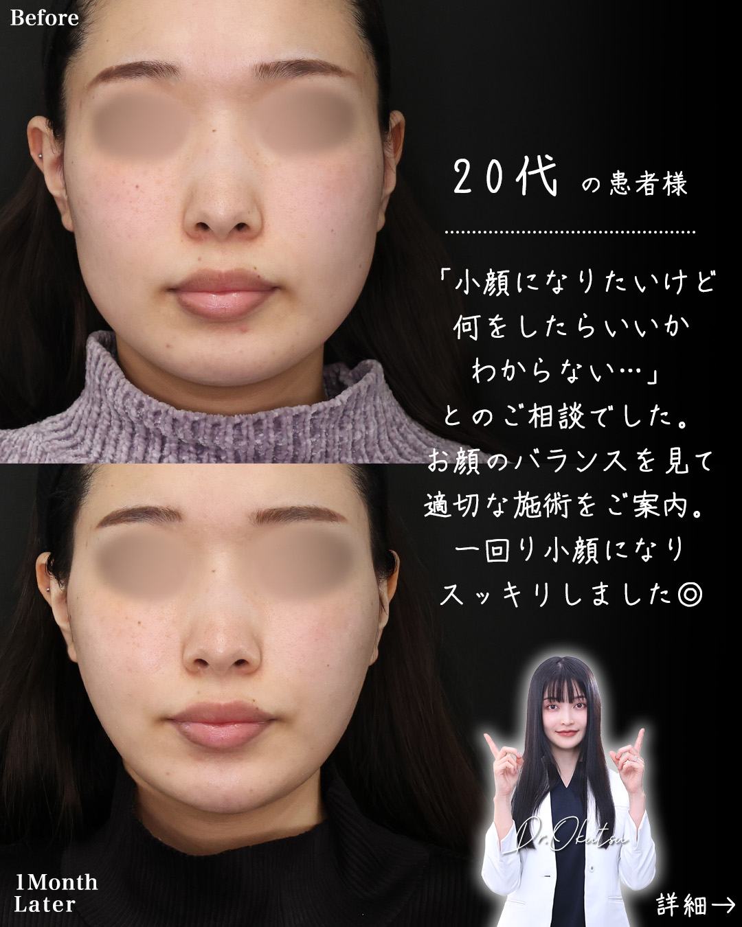 TAC式 ツヤ肌コラーゲンリフト®/Lラインファット除去（エラ下脂肪除去）/ジョールファット除去の症例写真 施術前後 