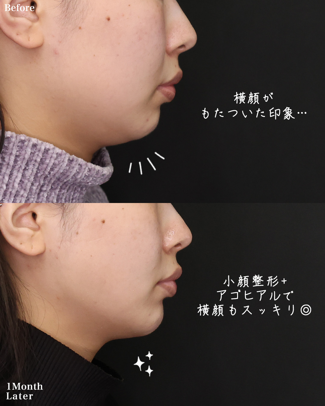 TAC式 ツヤ肌コラーゲンリフト®/Lラインファット除去（エラ下脂肪除去）/ジョールファット除去の症例写真 施術前後 