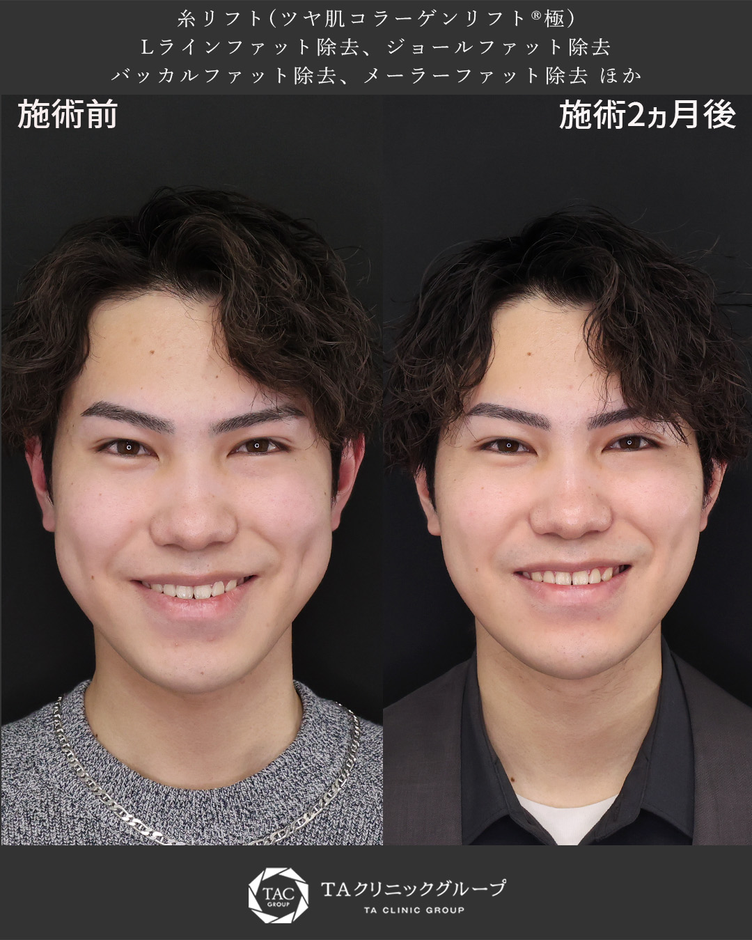 笑うと顔が大きく見える？頬の脂肪除去で解消した小顔整形