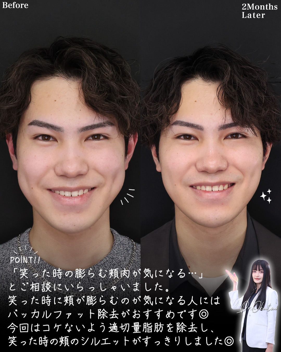 TAC式 ツヤ肌コラーゲンリフト®/バッカルファット除去/メーラーファット除去の症例写真 施術前後 