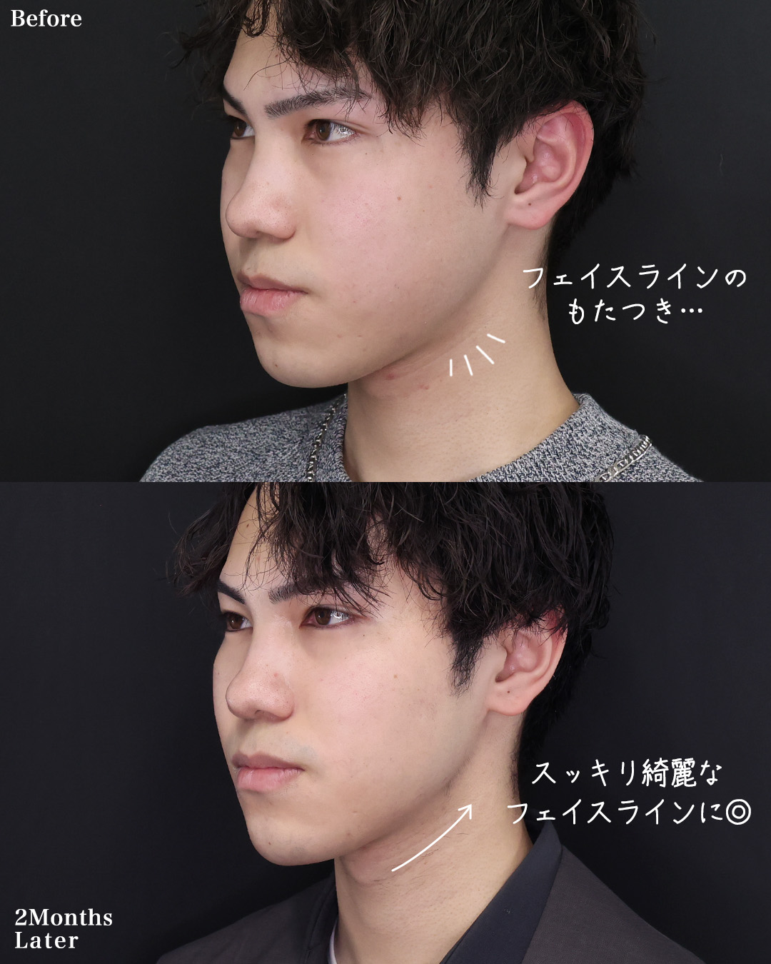 TAC式 ツヤ肌コラーゲンリフト®/バッカルファット除去/メーラーファット除去の症例写真 施術前後 