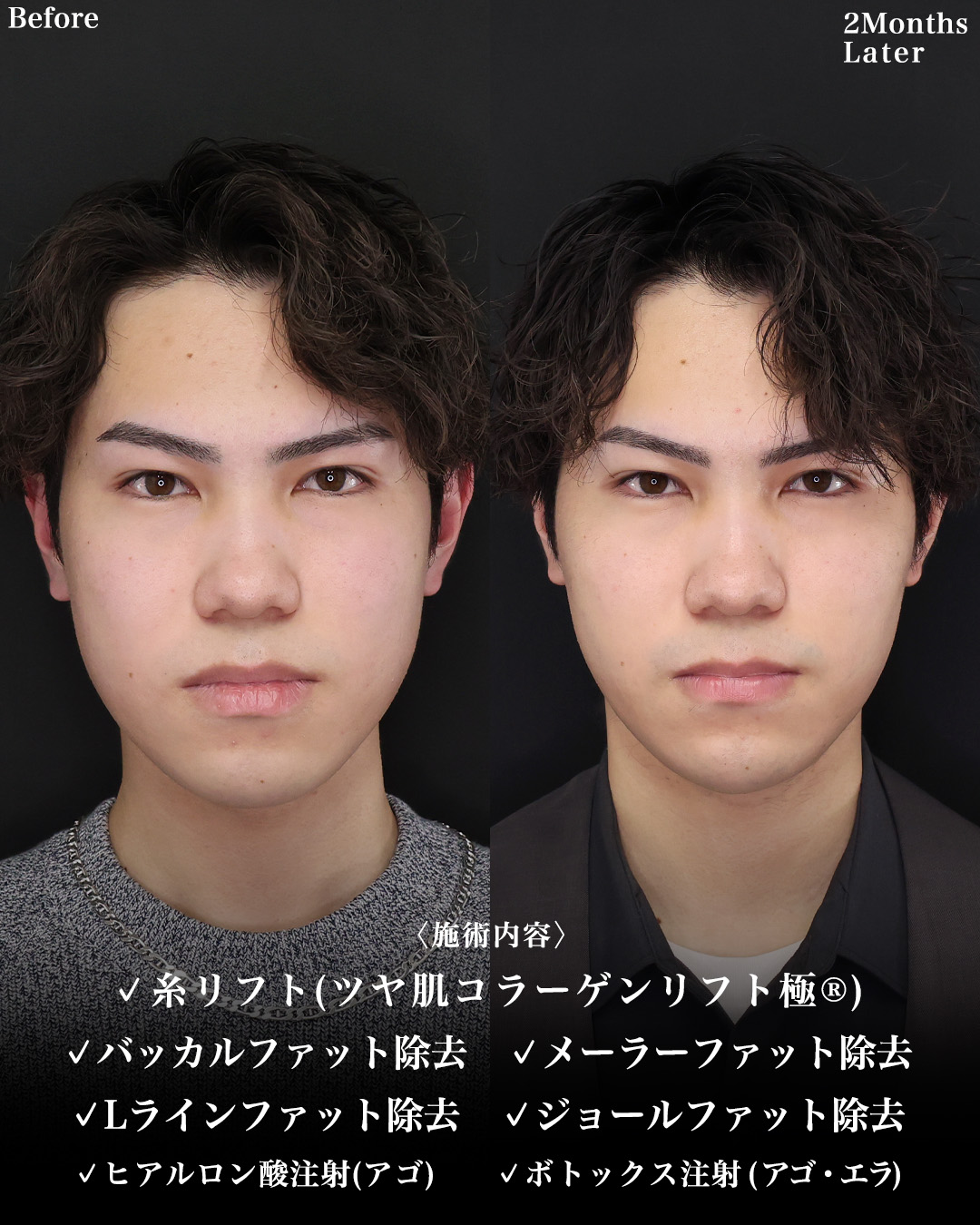 TAC式 ツヤ肌コラーゲンリフト®/バッカルファット除去/メーラーファット除去の症例写真 施術前後 