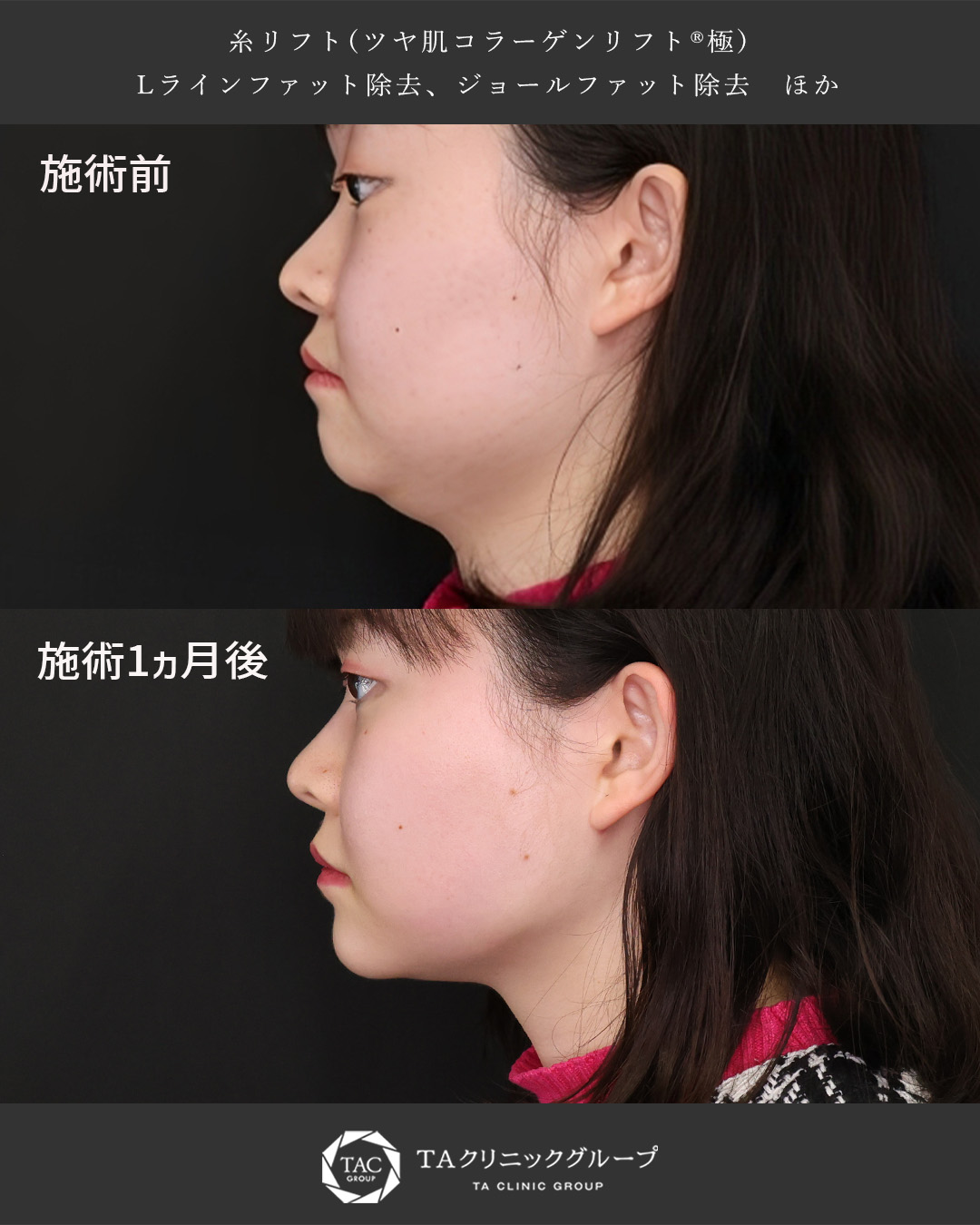 【20代女性症例】糸リフト×脂肪除去で小顔に!自信を持てる横顔に◎