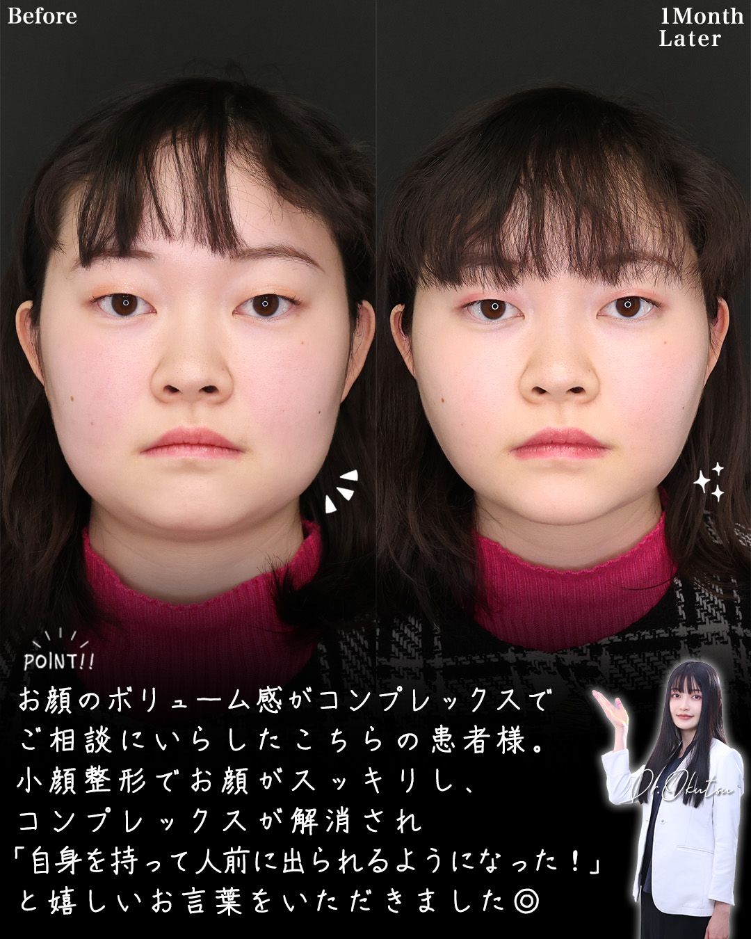 TAC式 ツヤ肌コラーゲンリフト®/ジョールファット除去/Lラインファット除去（エラ下脂肪除去）の症例写真 施術前後 