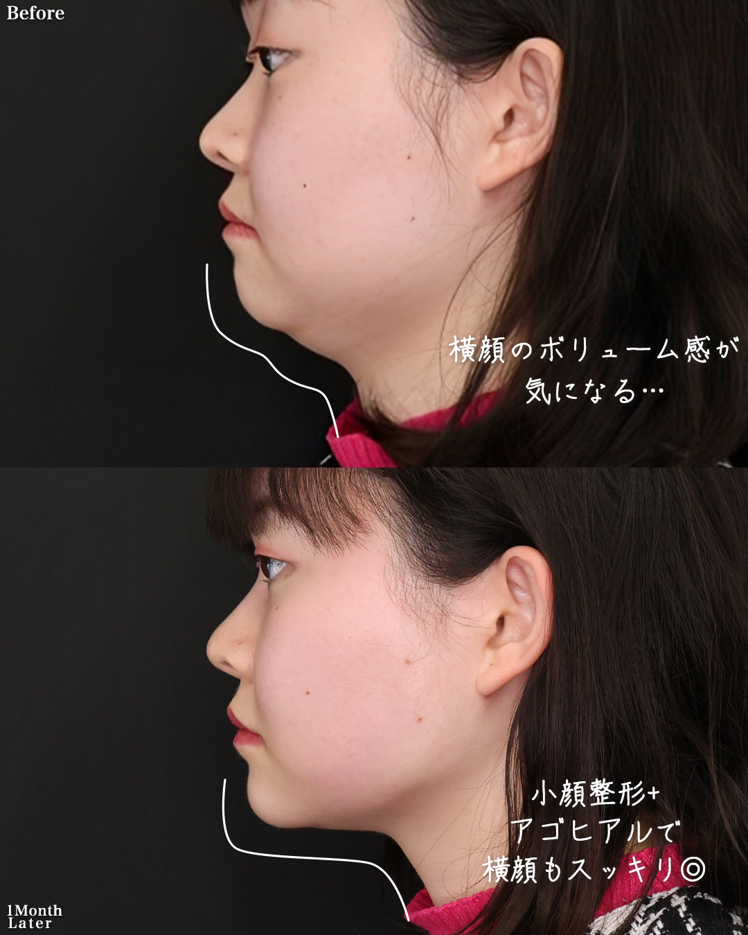 TAC式 ツヤ肌コラーゲンリフト®/ジョールファット除去/Lラインファット除去（エラ下脂肪除去）の症例写真 施術前後 