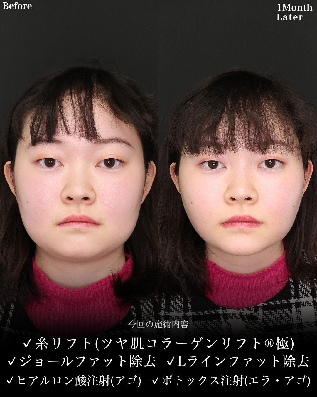 TAC式 ツヤ肌コラーゲンリフト®/ジョールファット除去/Lラインファット除去（エラ下脂肪除去）の症例写真 施術前後 