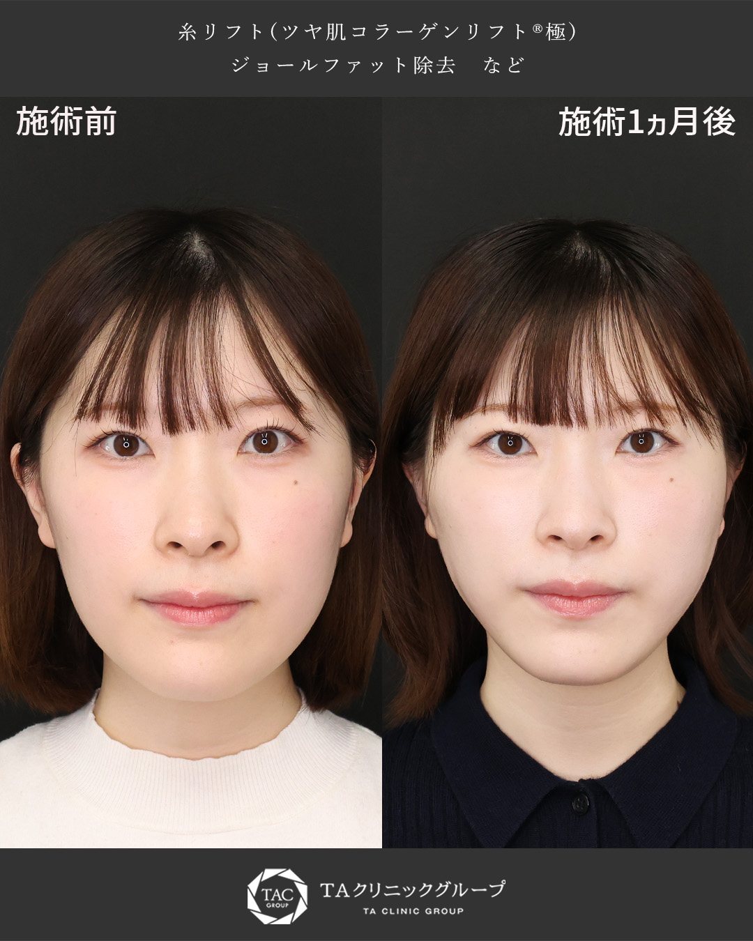 【20代女性症例】糸リフト＋ジョールファット除去で面長感を解消し小顔に