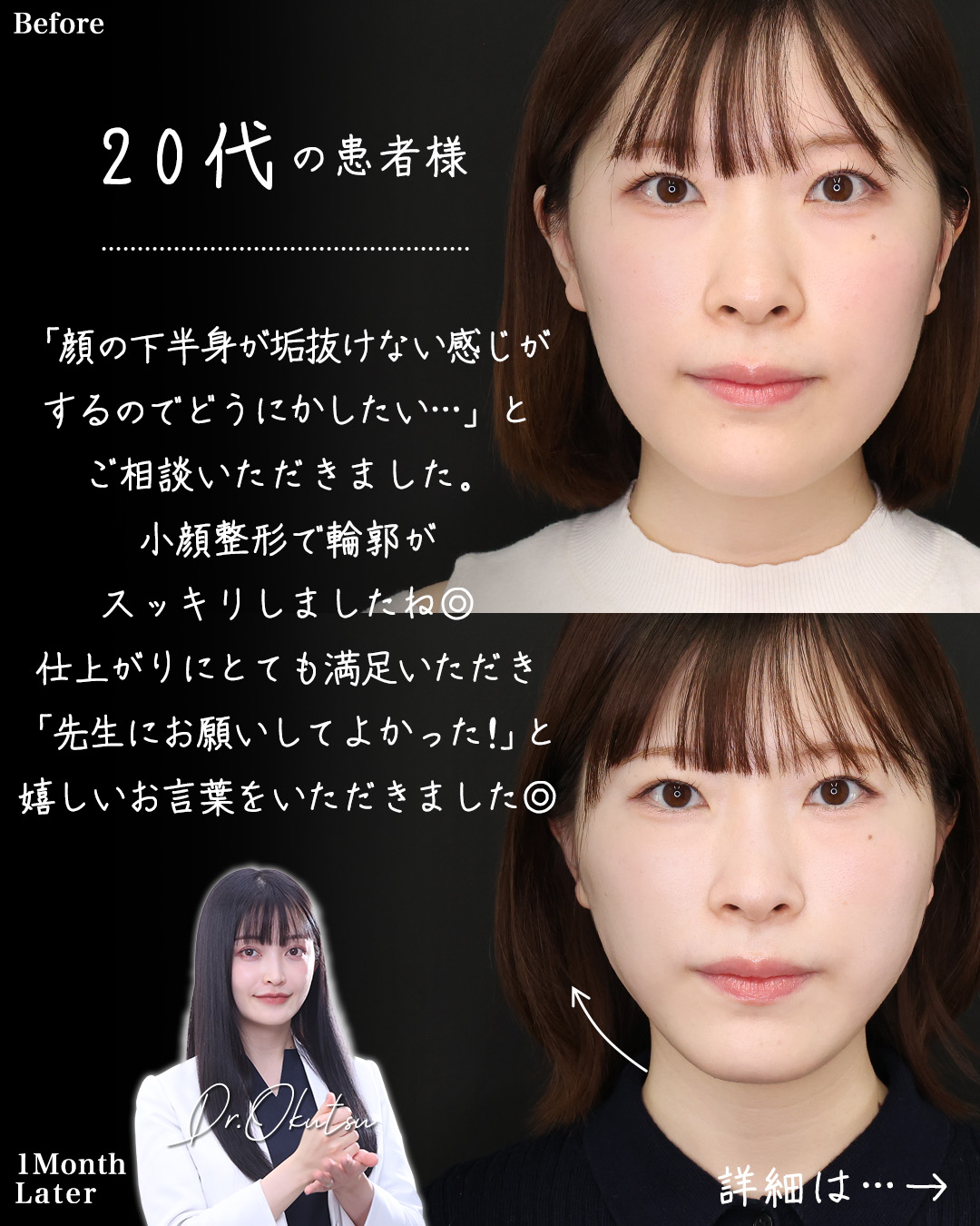 TAC式 ツヤ肌コラーゲンリフト®/ジョールファット除去/マリオネットラインのヒアルロン酸注射の症例写真 施術前後 