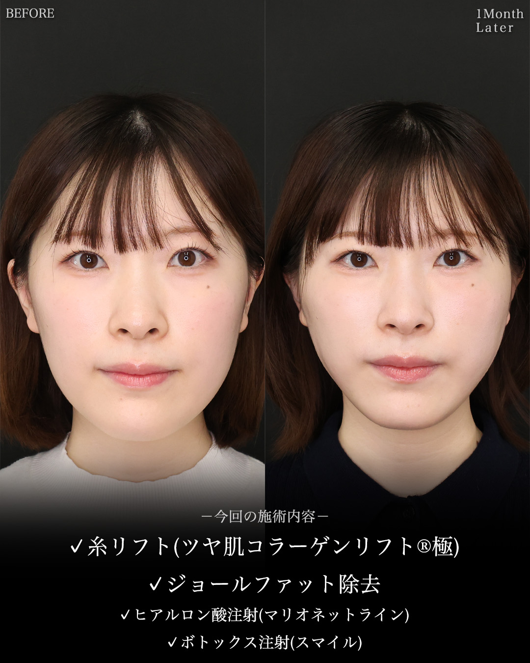 TAC式 ツヤ肌コラーゲンリフト®/ジョールファット除去/マリオネットラインのヒアルロン酸注射の症例写真 施術前後 