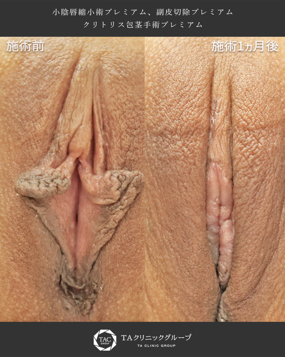 20代女性の小陰唇縮小＋副皮切除＋クリトリス包茎手術症例｜擦れ・黒ずみ・痛み解消
