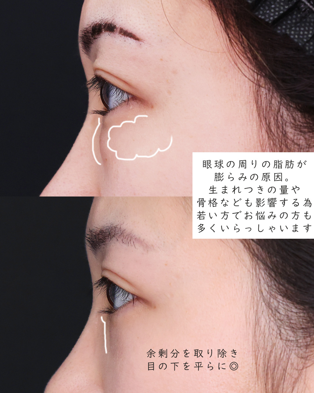 下眼瞼脱脂術（目の下のたるみ取り・目の下の脂肪ふくらみ取り）の症例写真 施術前後 