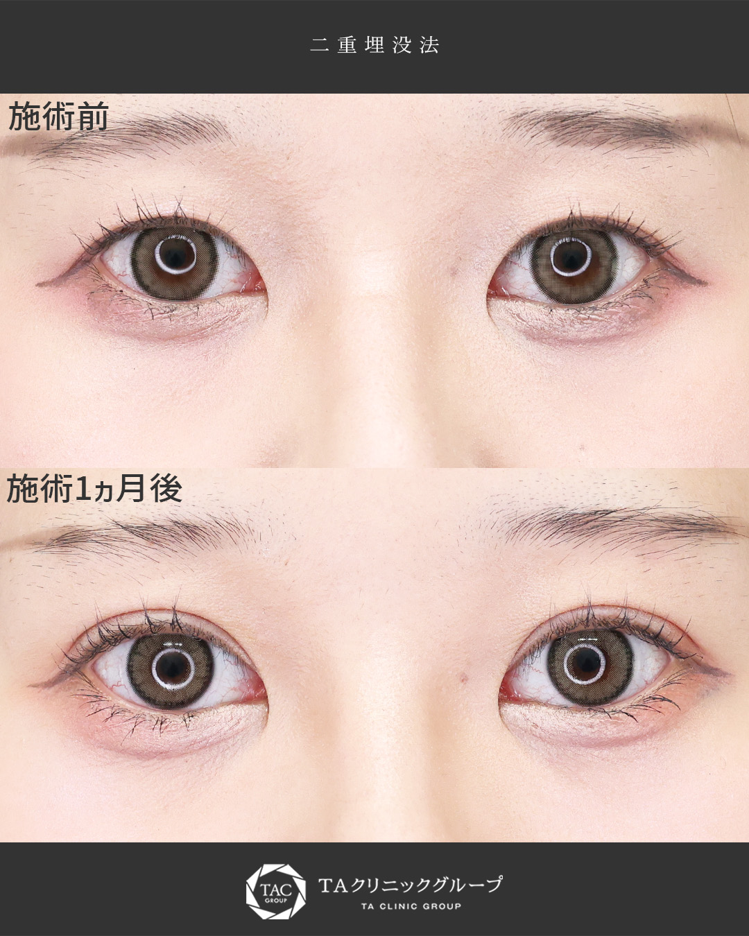 【幅調整】自然な幅でもっと可愛いお目元に