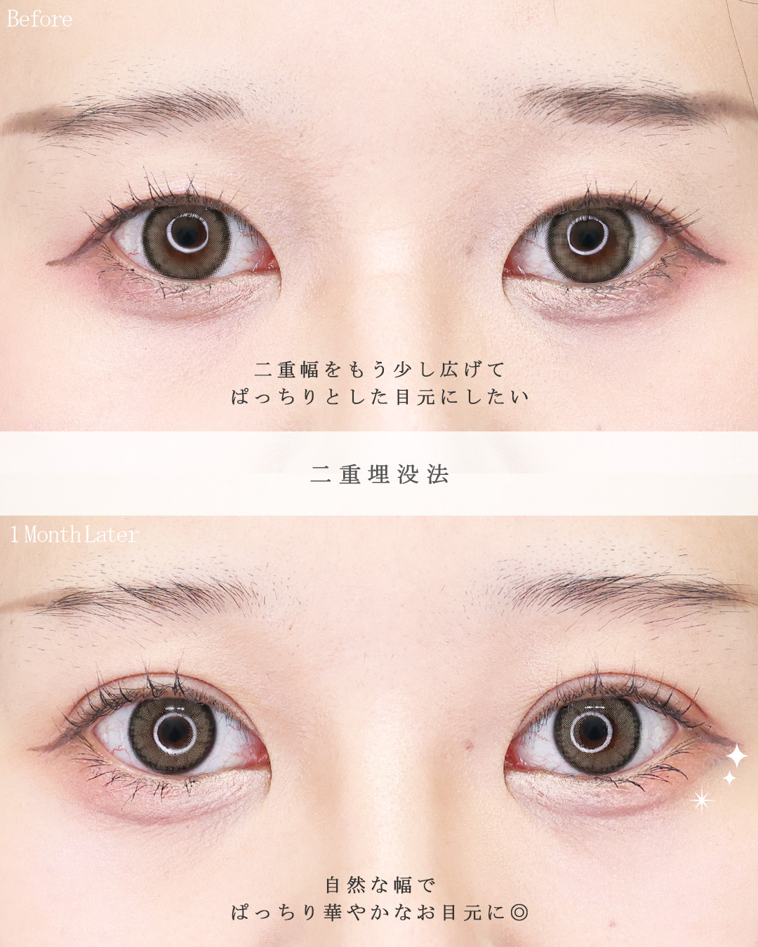 二重埋没法の症例写真 施術前後 