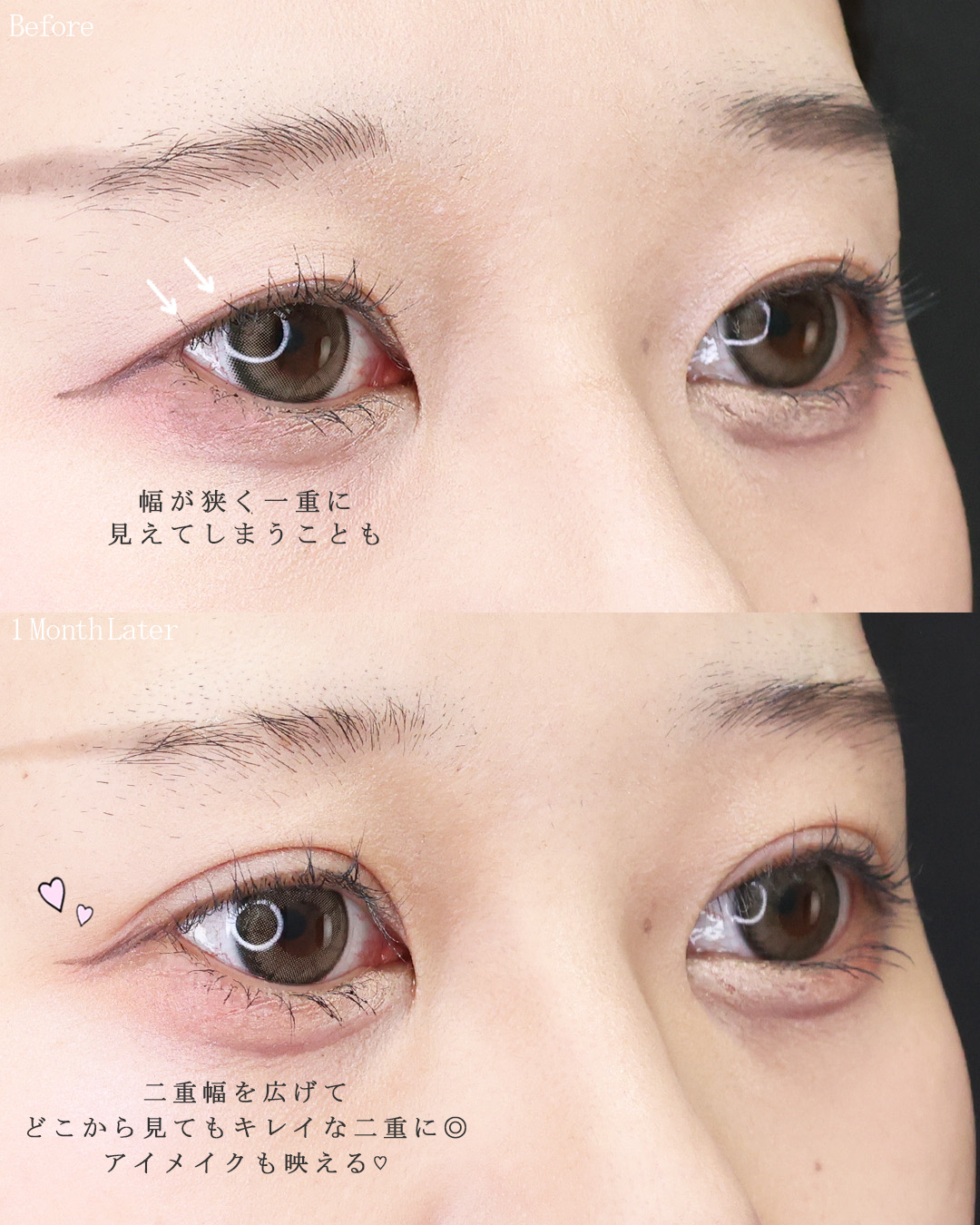 二重埋没法の症例写真 施術前後 