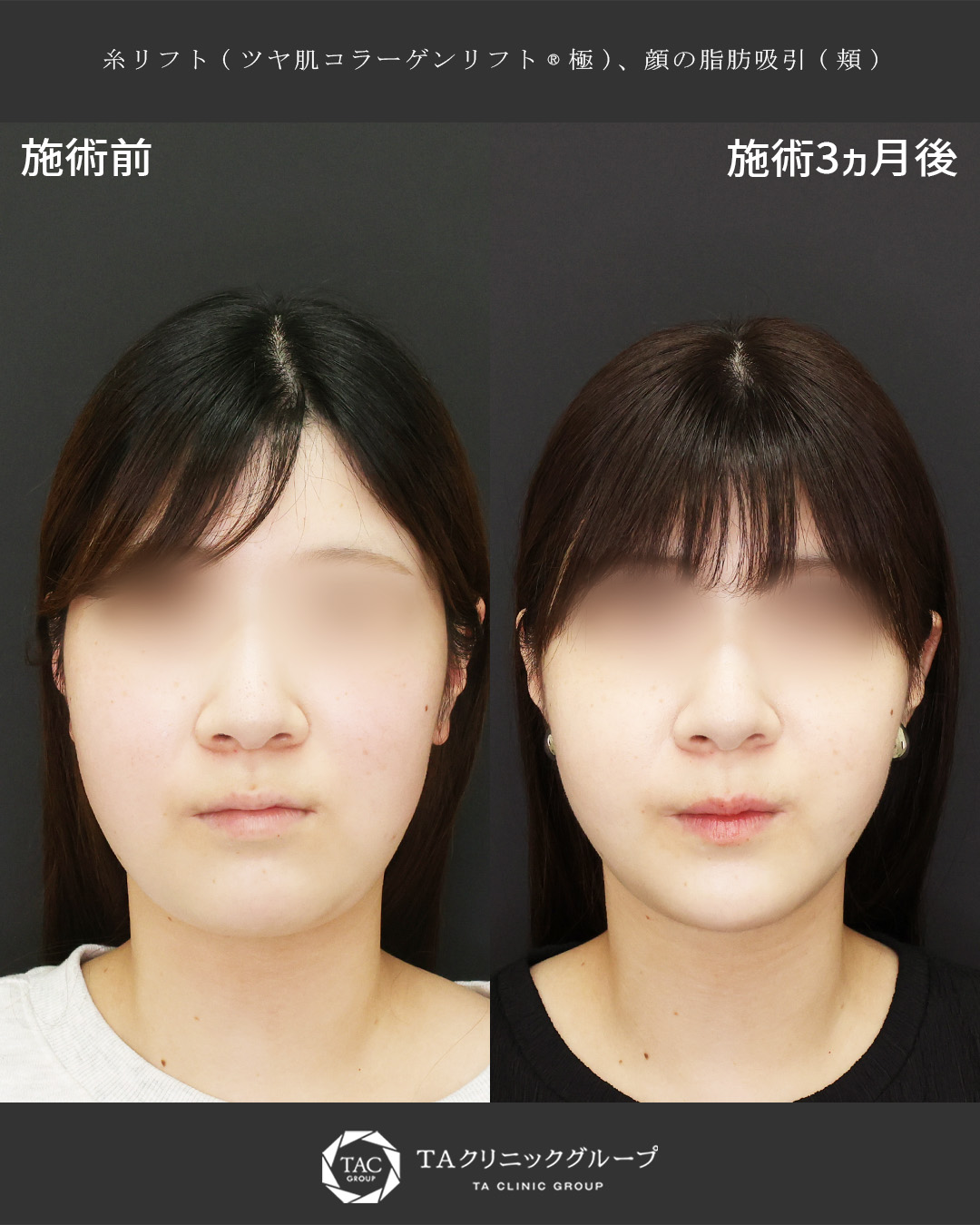 【頬のつまめるお肉を減らす】頬の脂肪吸引×糸リフトで小顔に