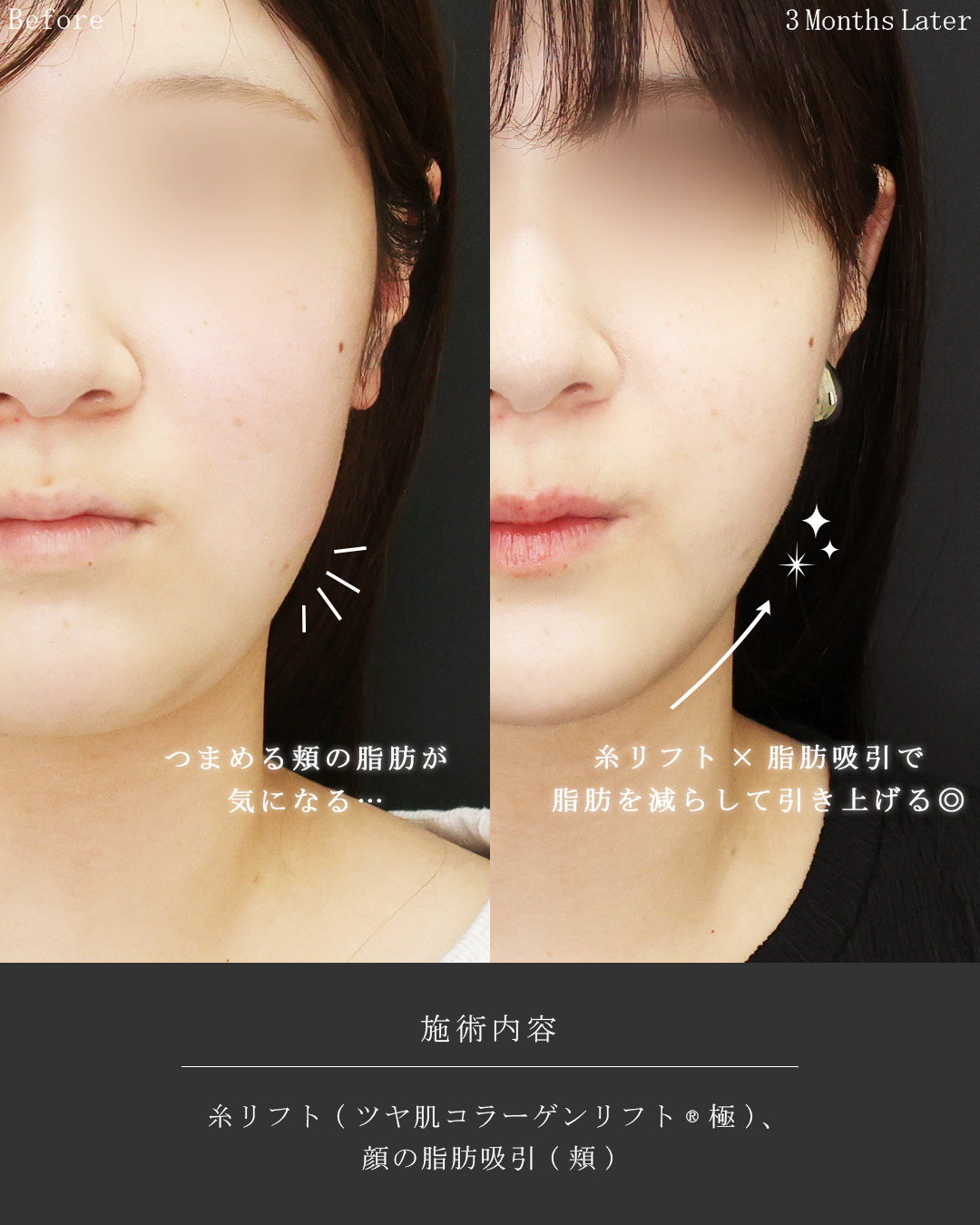TAC式 ツヤ肌コラーゲンリフト®/顎下の脂肪吸引の症例写真 施術前後 