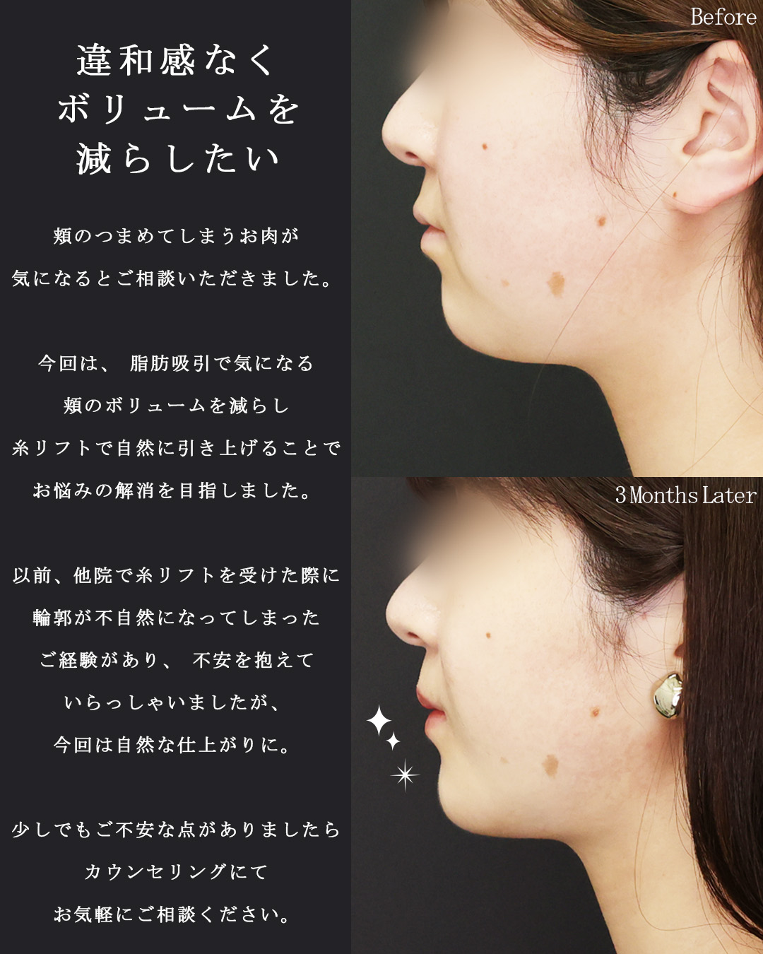 TAC式 ツヤ肌コラーゲンリフト®/顎下の脂肪吸引の症例写真 施術前後 