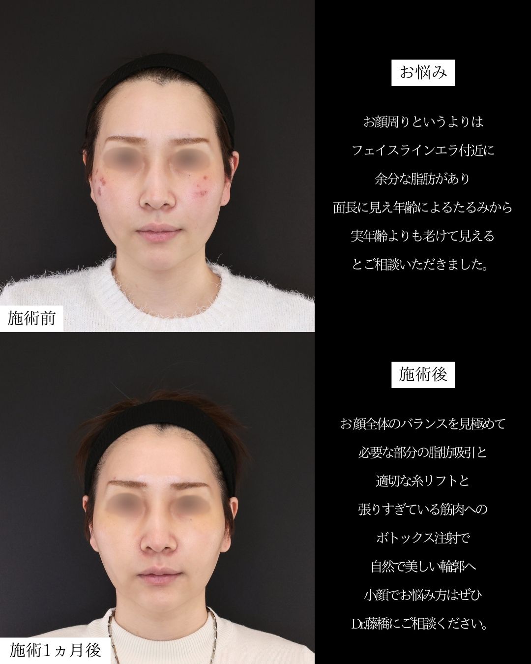 TAC式 ツヤ肌コラーゲンリフト®/Lラインファット除去(エラ下脂肪除去)/ボトックス注射:その他の症例写真 施術前後