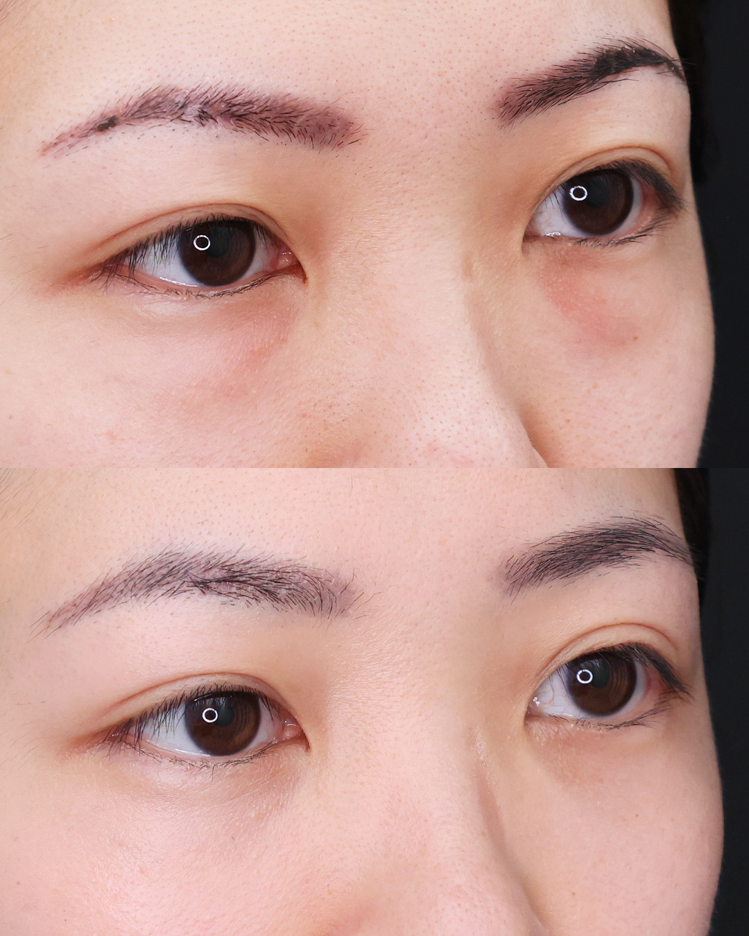 下眼瞼脱脂術（目の下のたるみ取り・目の下の脂肪ふくらみ取り）の症例写真 施術前後 