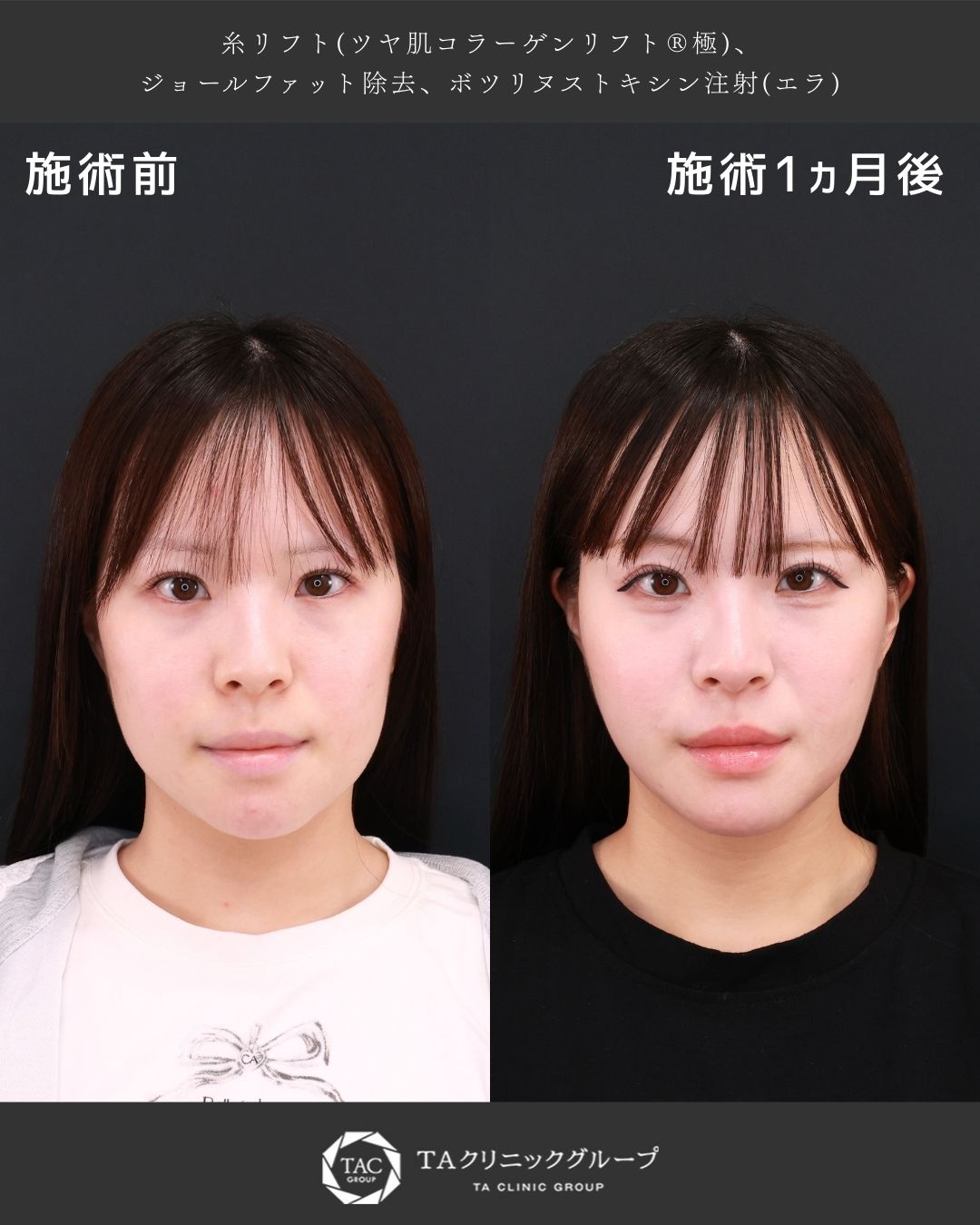 TAC式 ツヤ肌コラーゲンリフト®/ジョールファット除去/エラボトックス注射の症例写真 施術前後 