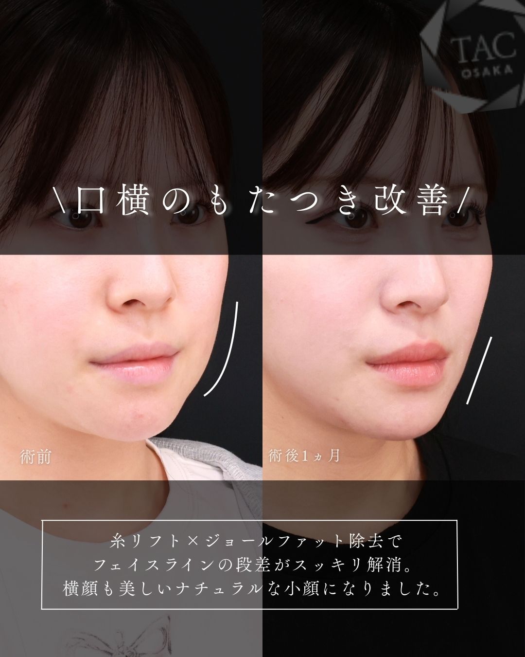 TAC式 ツヤ肌コラーゲンリフト®/ジョールファット除去/エラボトックス注射の症例写真 施術前後 