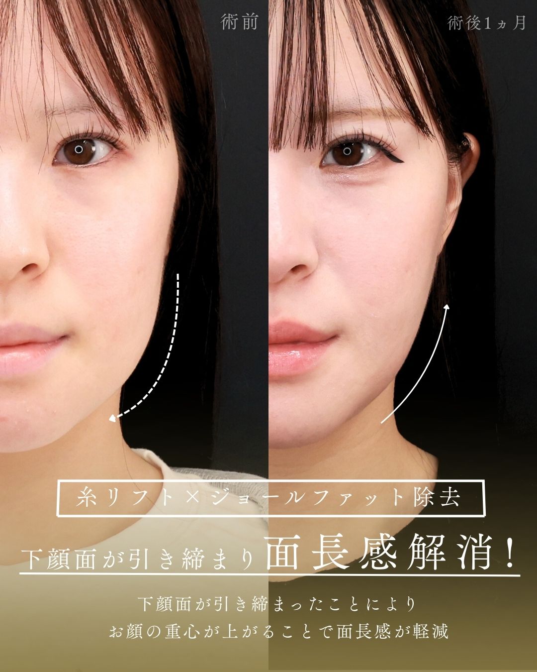 TAC式 ツヤ肌コラーゲンリフト®/ジョールファット除去/エラボトックス注射の症例写真 施術前後 