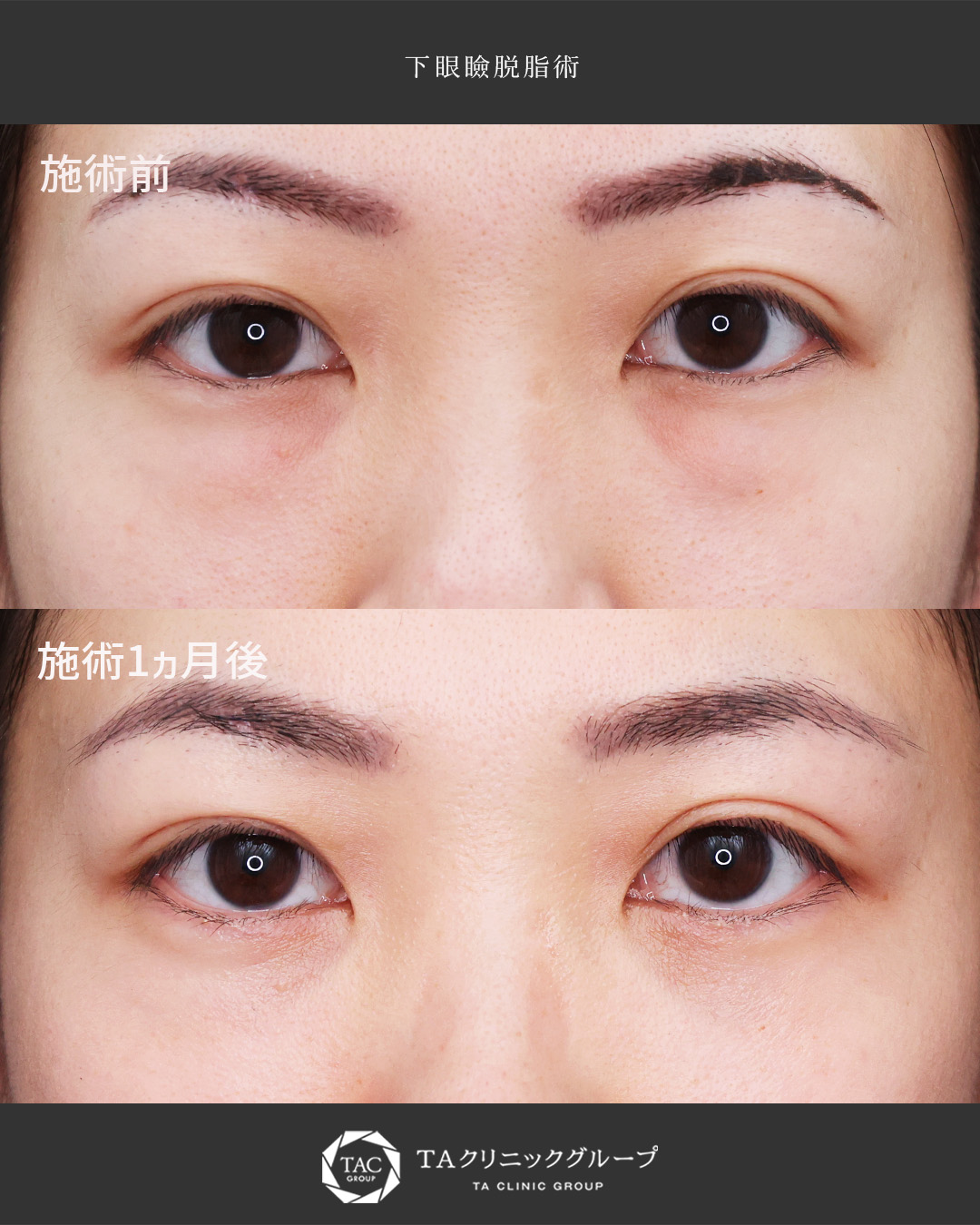 学生時代からの悩みを解消◎【30代・クマ治療】