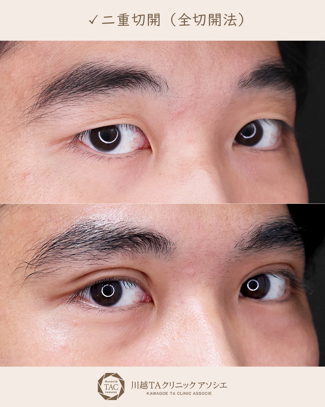 二重切開（全切開法）の症例写真 施術前後 