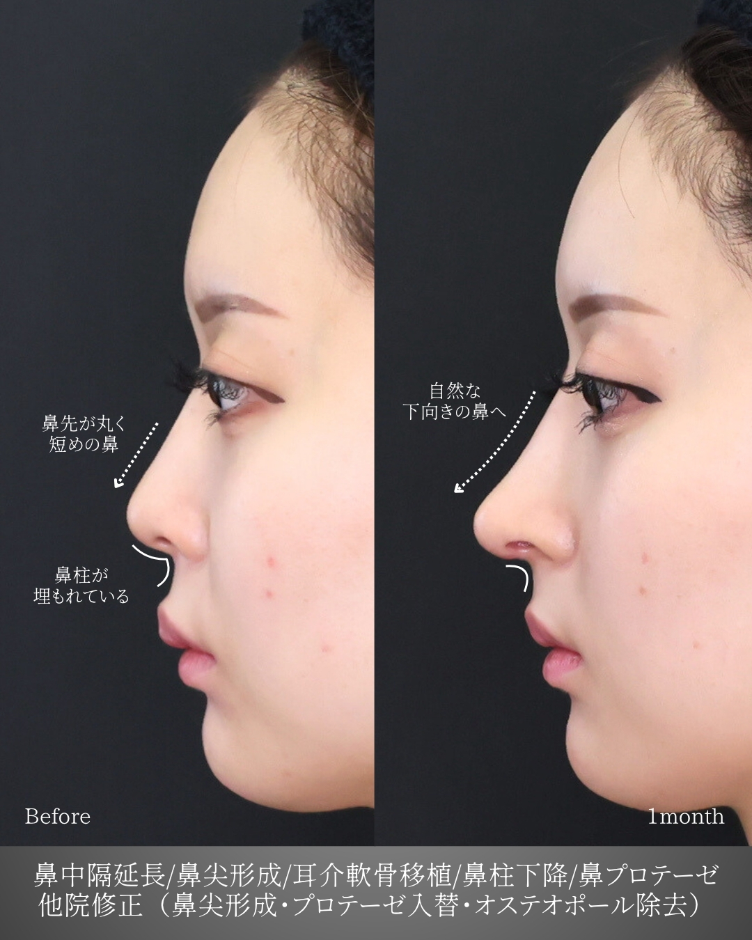 鼻中隔延長術/鼻尖形成・鼻尖縮小/鼻先軟骨移植の症例写真 施術前後 