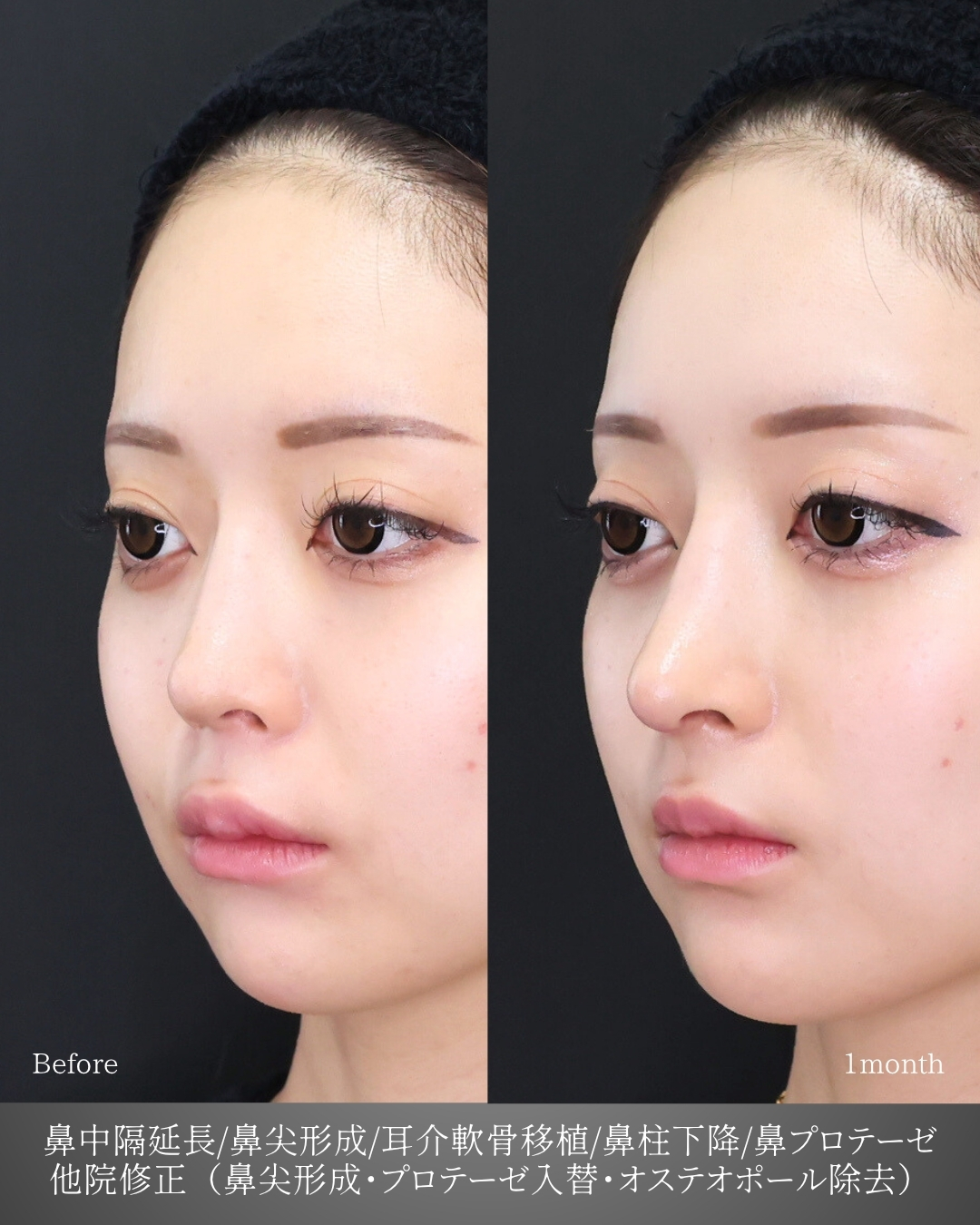 鼻中隔延長術/鼻尖形成・鼻尖縮小/鼻先軟骨移植の症例写真 施術前後 